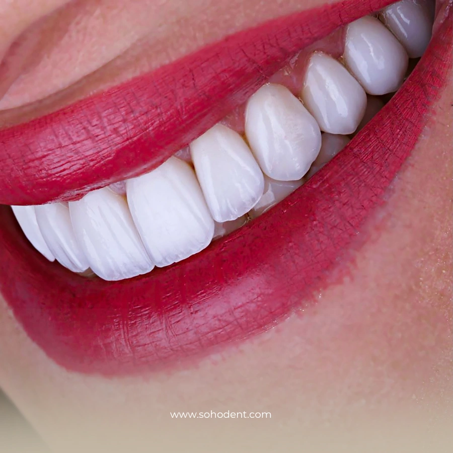 Dental Veneers Cost in Turkey