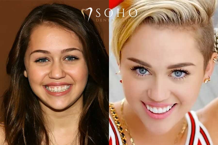 miley cyrus dentures 