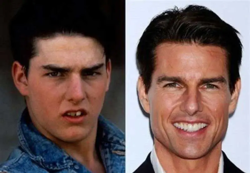 Tom Cruise Teeth