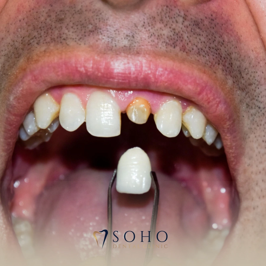 What to Do Immediately After Chipping a Dental Crown