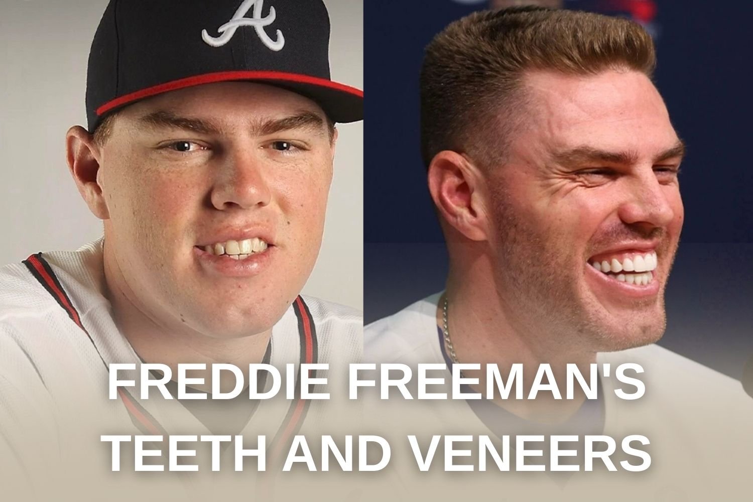 Freddie Freeman's Teeth and Veneers