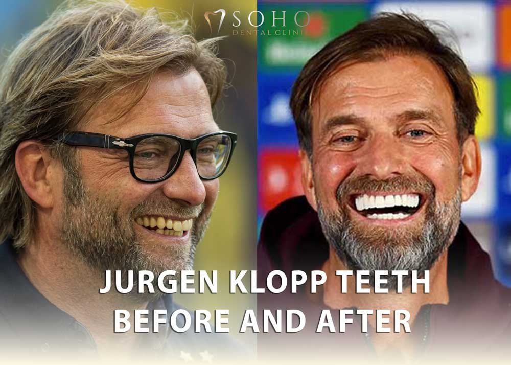 jurgen klopp teeth before and after