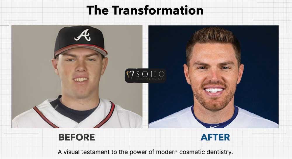 freddie freeman teeth before and after