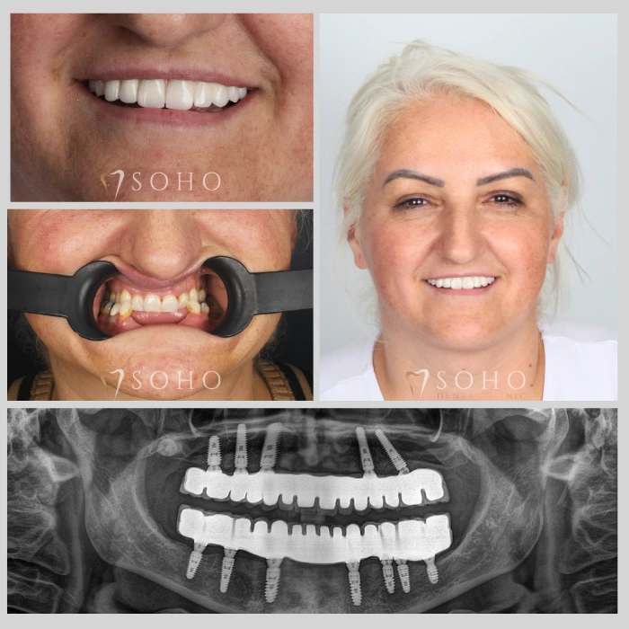 Before and after all on 4 dental implants