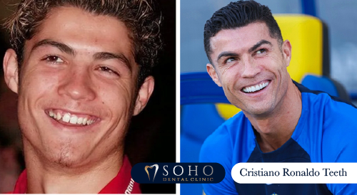 Cristiano Ronaldo Teeth