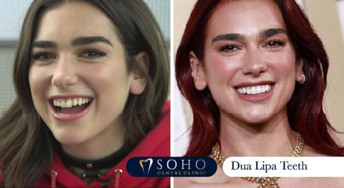 dua-lipa-teeth