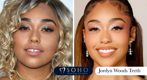 jordyn-woods-teeth