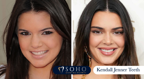kendall-jenner-teeth