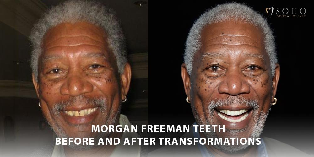 morgan freeman teeth