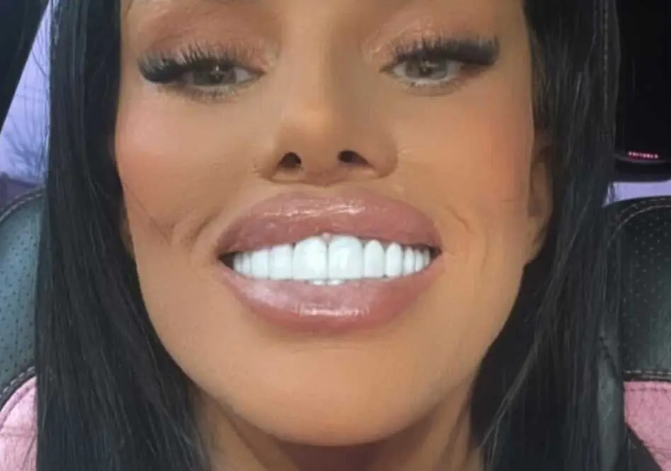 Katie Price Teeth Stumps  Veneer Mechanics