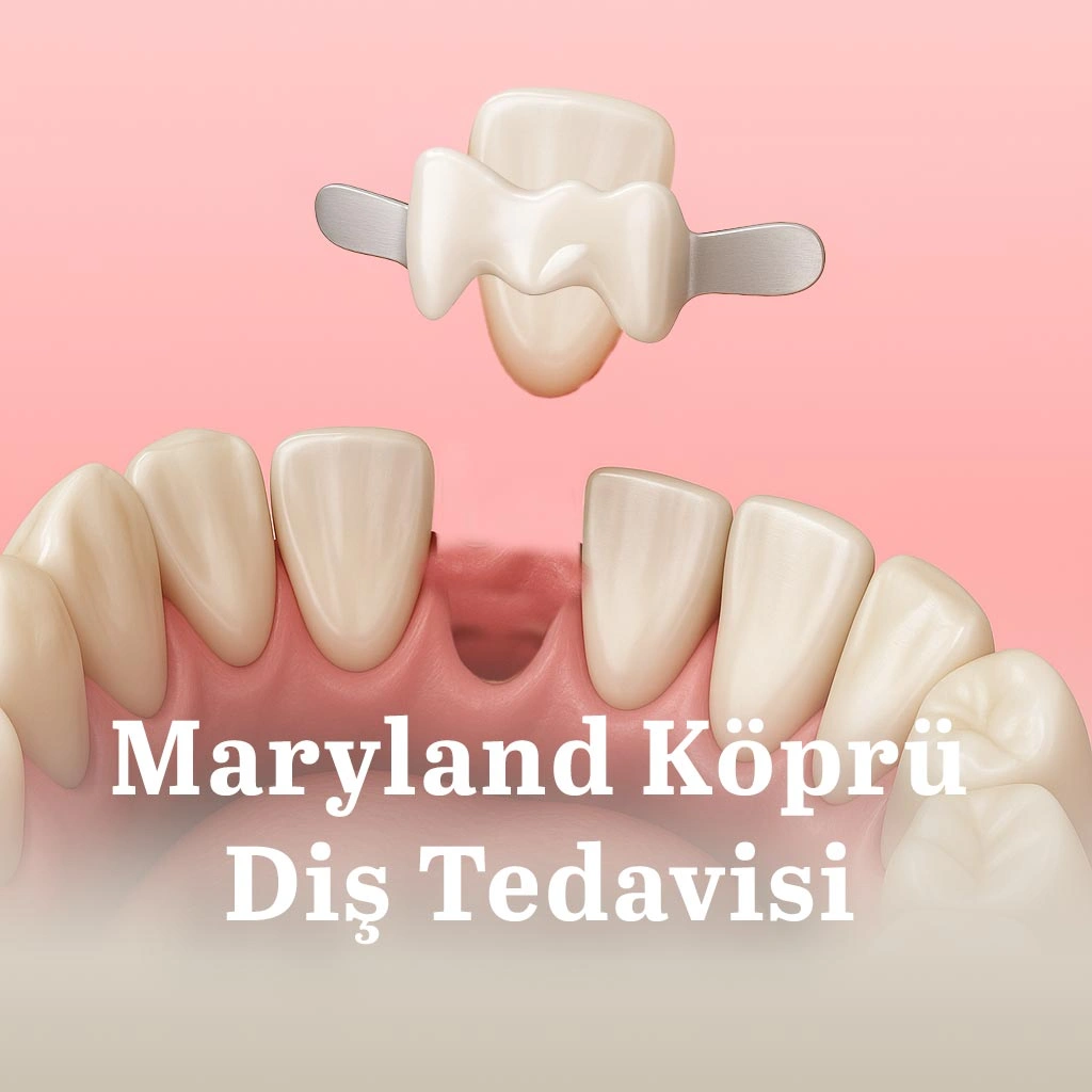 Maryland Köprü Diş Tedavisi nedir