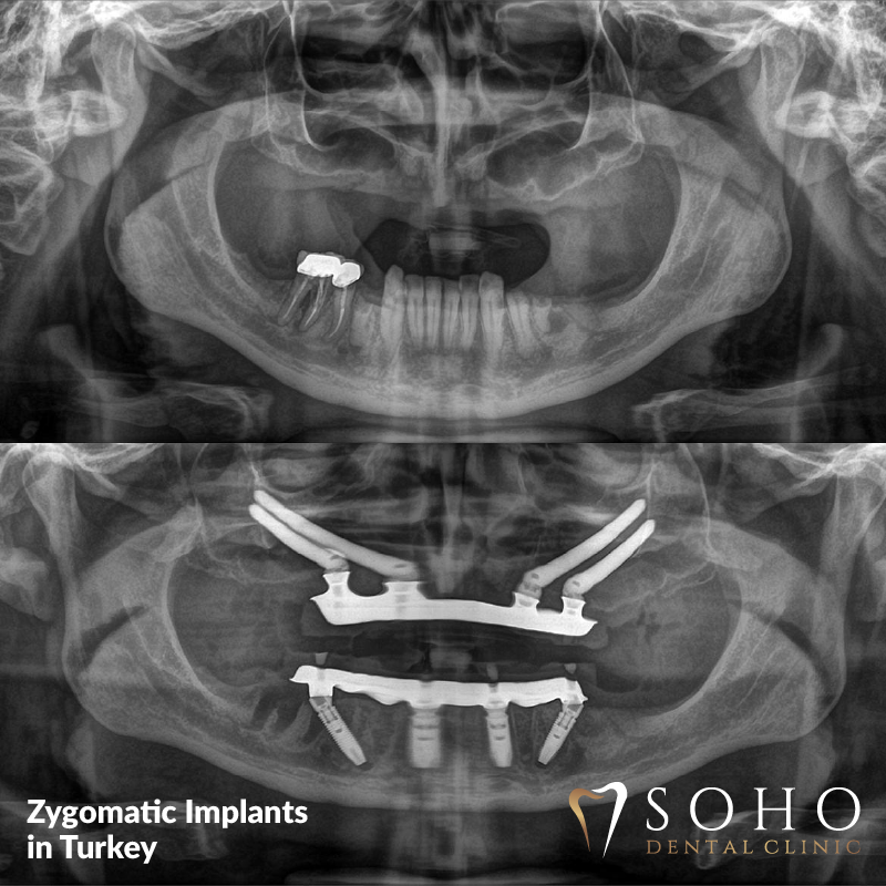 Zygomatic and Pterygoid (Cheekbone) Implants in istanbul - dental implants in cheekbone