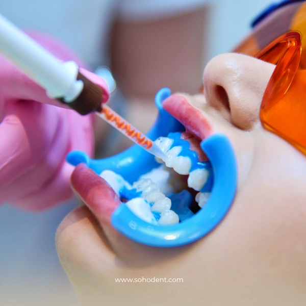Is Teeth Cleaning in Istanbul Safe