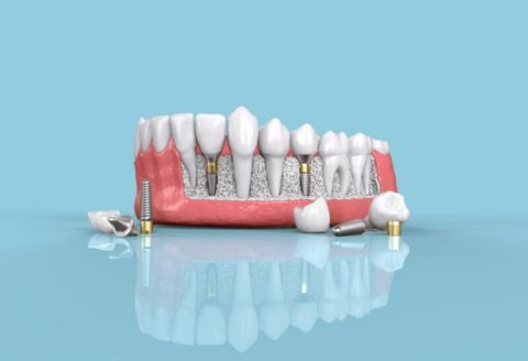 dental-implant-01