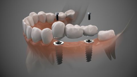 dental-implant-03